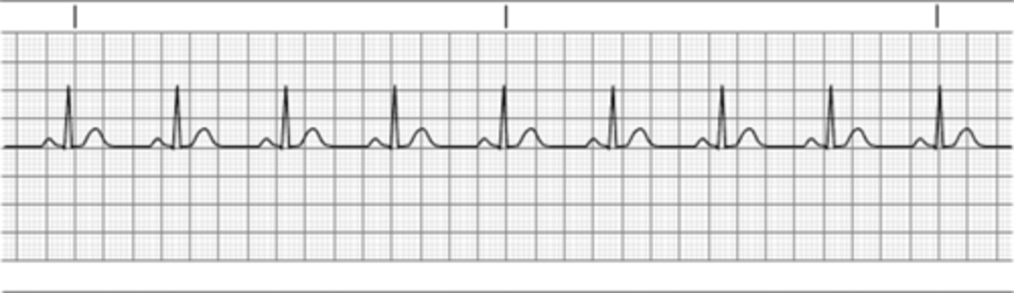 <p>Count the # of big blocks between QRS complexes then divide into 300.</p><p>Ex. 300/3.5= 86</p>