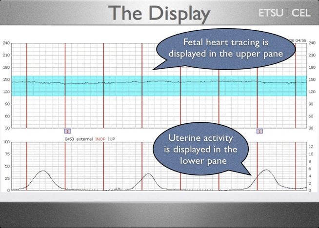 <ul><li><p>Machine that simultaneously records fetal heart rate and uterine contractions</p><ul><li><p>Fetal heart rate → via an ultrasound doppler transducer</p></li><li><p>Uterine contractions → via tocodynamometer</p></li><li><p>Top part is baby and bottom is mom</p></li></ul></li><li><p>From one red line to another red line is 1 minute </p><ul><li><p>Each box is 10 seconds </p></li></ul></li></ul><p></p><p></p>