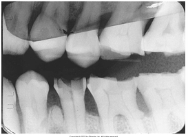 <p>What is the problem with this OVERLAPPED FILMS X-ray?</p>