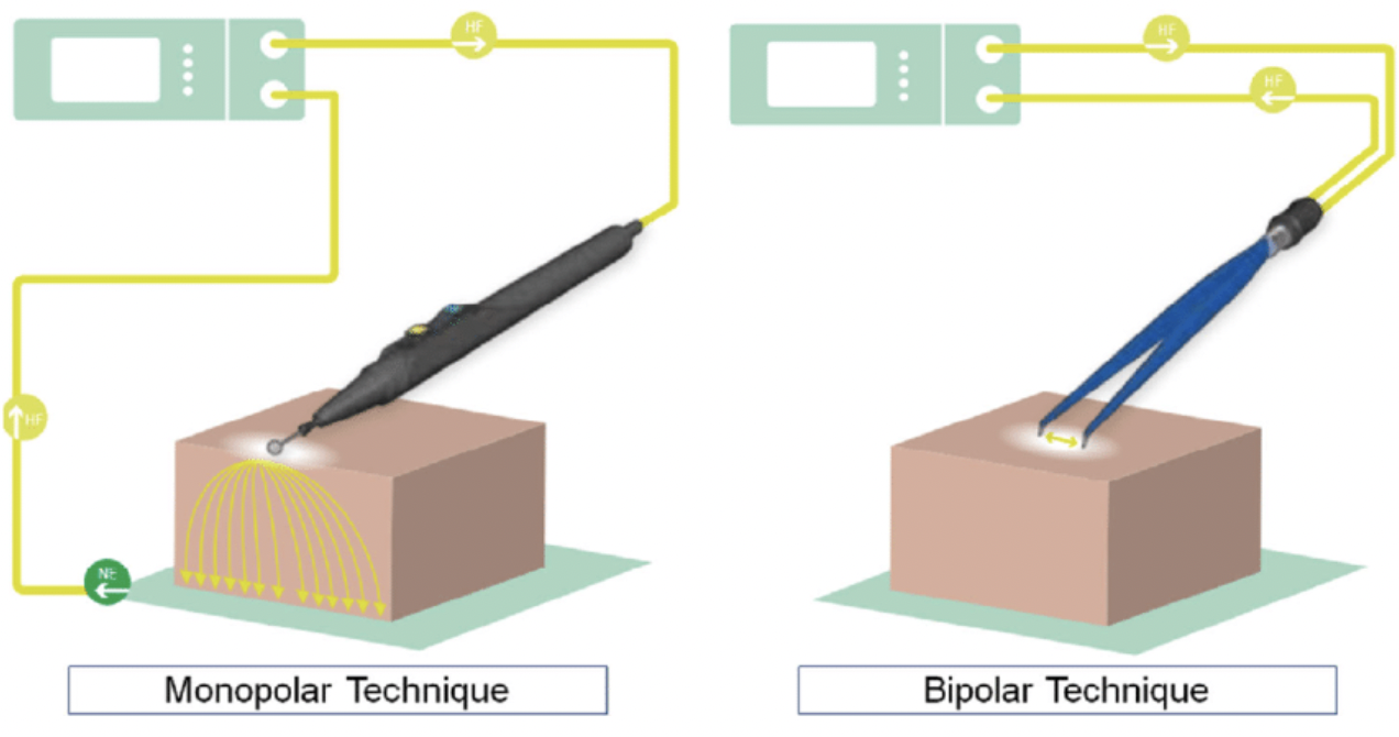 <p><strong>Monopolar Electrosurgery</strong></p><p><u>Mechanism:</u> Active electrode at surgical site and return electrode (dispersive pad) elsewhere on patient</p><ul><li><p>Current passes through patient and resistance generated produces heat</p></li><li><p>Resistance inversely proportional to SA (resistance decreases as current spread through body)</p></li></ul><p><span style="color: red;"><u>Disadvantage:</u> Cannot work in wet field (eg. blood) as current will disperse throughout fluid and target tissue will not heat effectively</span></p><p></p><p><strong>Bipolar Electrosurgery</strong></p><p><u>Mechanism:</u> Active AND return electrode at surgical site</p><ul><li><p>Current passes through tissue grasped by forceps</p></li></ul><p><span style="color: green;"><u>Advantage:</u> Works in ALL types of environments (eg. fluid)</span></p>