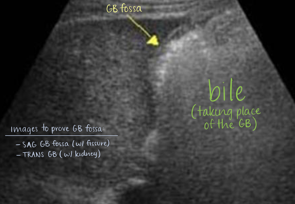 <p><span style="color: yellow;">removal of GB</span> —></p><ul><li><p>sphincter of Oddi loses tonus</p></li><li><p>bile flows freely into duodenum (biloma)</p></li><li><p>extrahepatic bile ducts dilate, <u>up to 1 cm</u></p></li></ul><p></p>