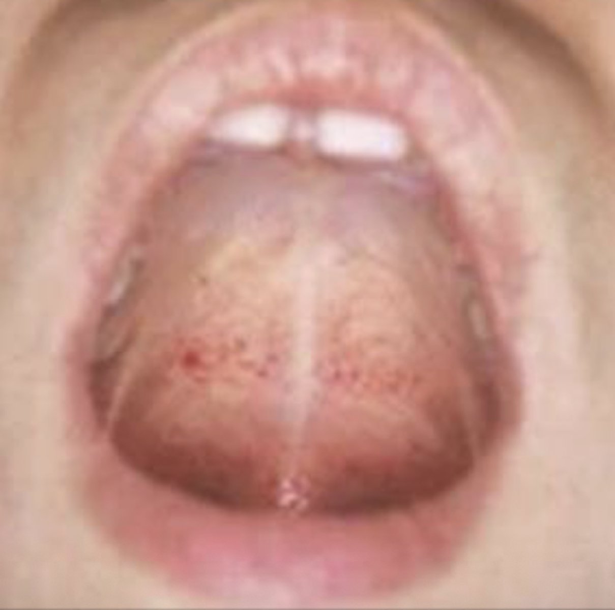 <p>Unexplained injury or petechiae of the palate at junction of hard and soft palate</p>