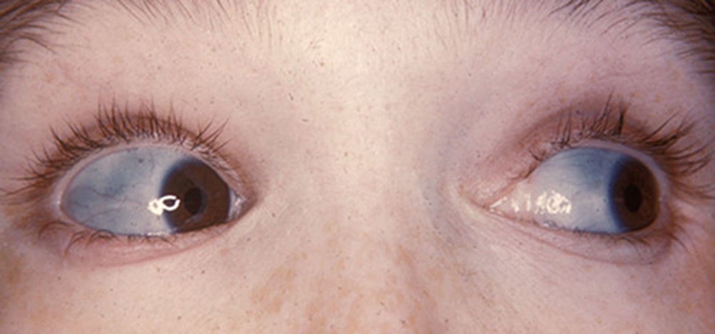 <p>dentinogenesis imperfecta</p><p>- question stem refers to a picture of blue sclera</p>
