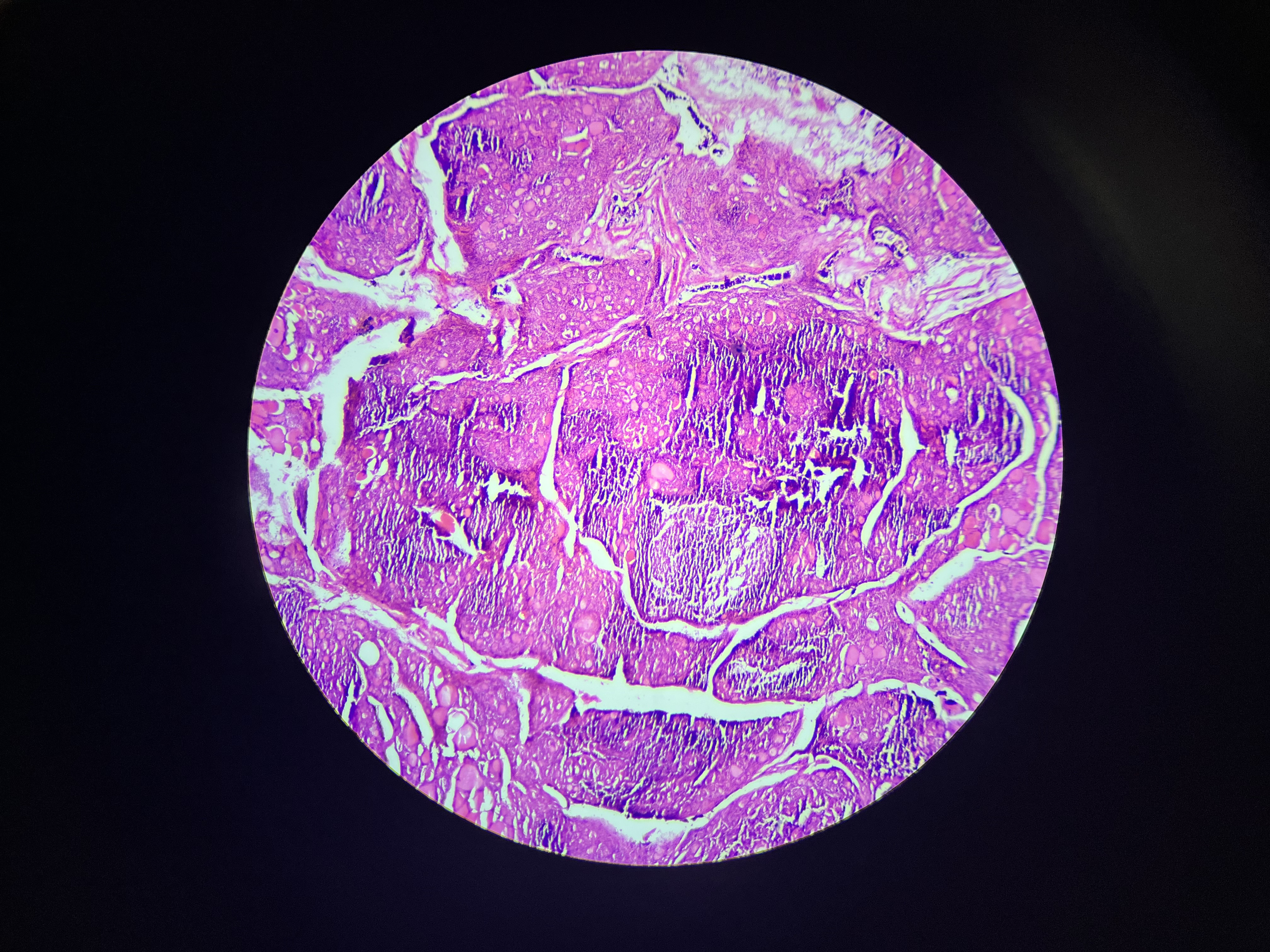 <p>An autoimmune disorder where the immune system attacks the thyroid gland, leading to hypothyroidism and often characterized by thyroid enlargement. </p>