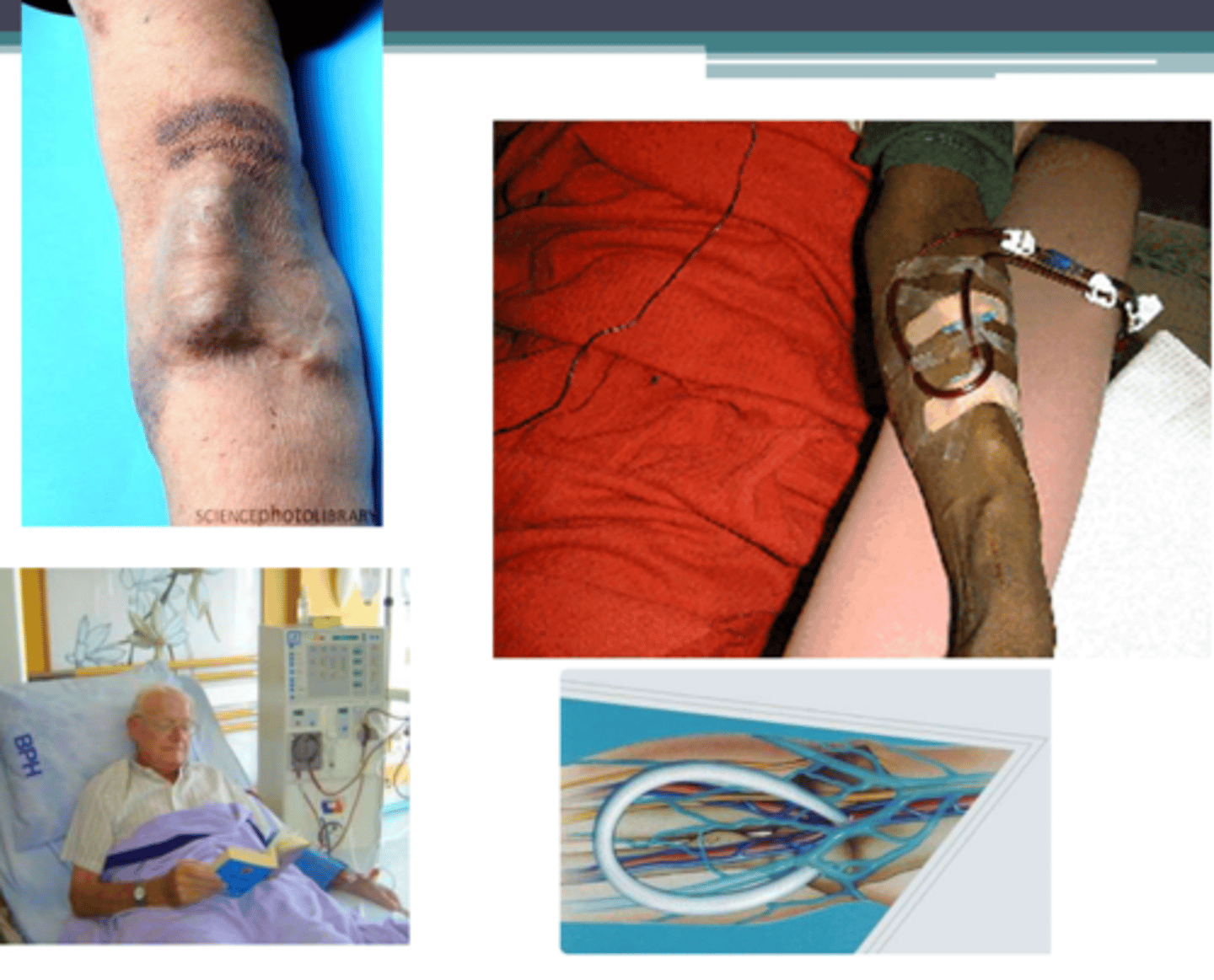 <p>Access for hemodialysis; connection between an artery and a vein.</p>