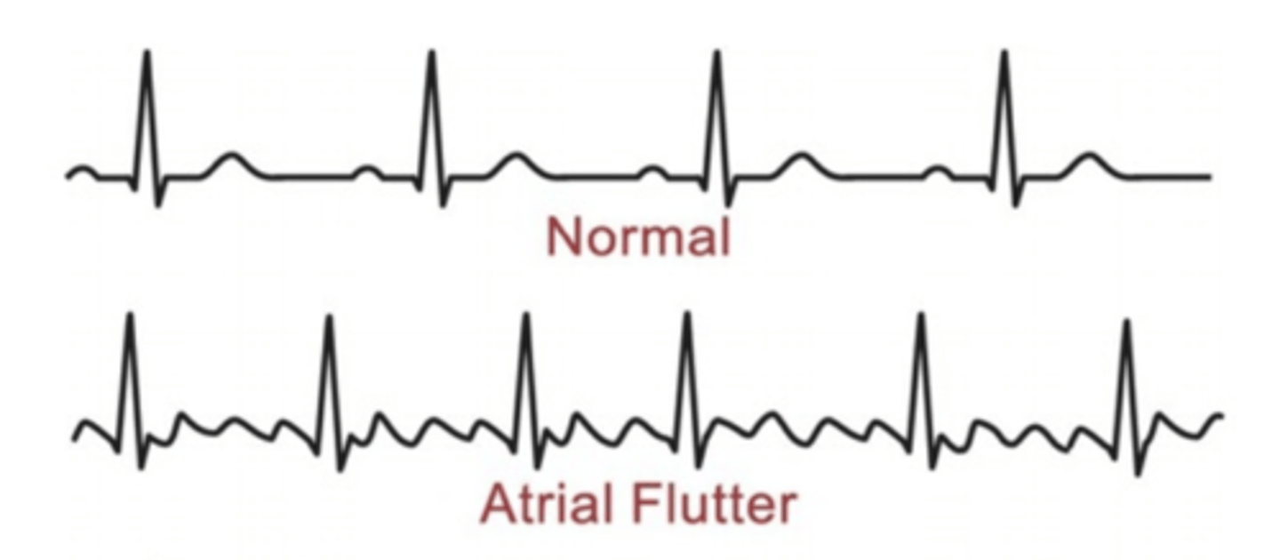 <p>Depolarization currents arise from SA but atrial rate too high for all impulses to be conducted through the AV node <br><br>FAST</p>