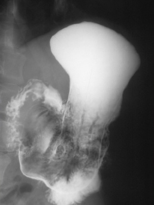<p>What is this x-ray demonstrating?</p>