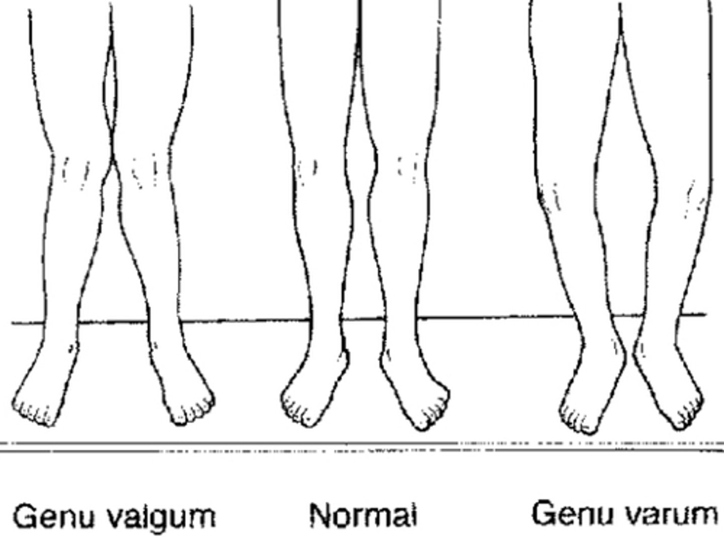 <p>genu varum = bowlegs</p><p>genu valgum= knock knees</p>