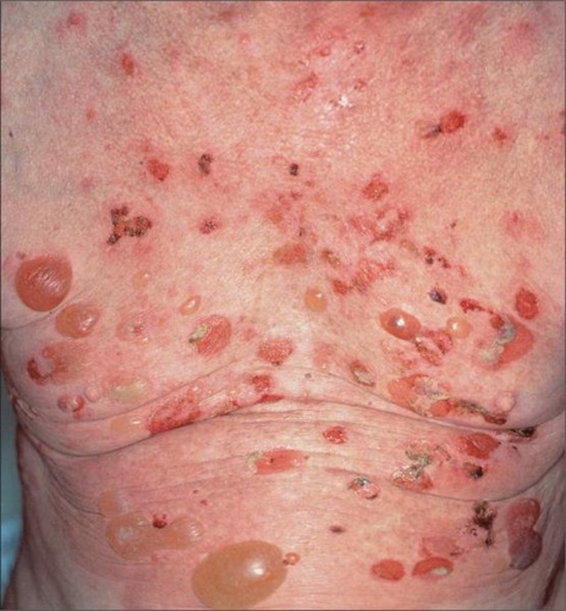 <p>Bullous Pemphigoid</p>