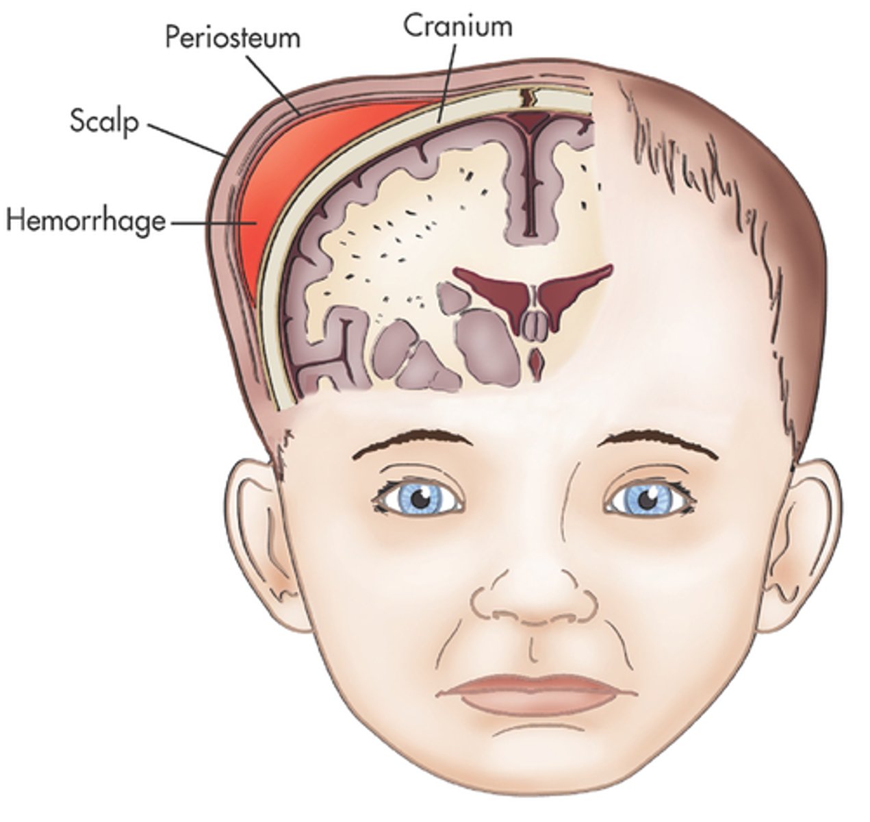 <p>cephalohematoma → takes several months to heal</p>