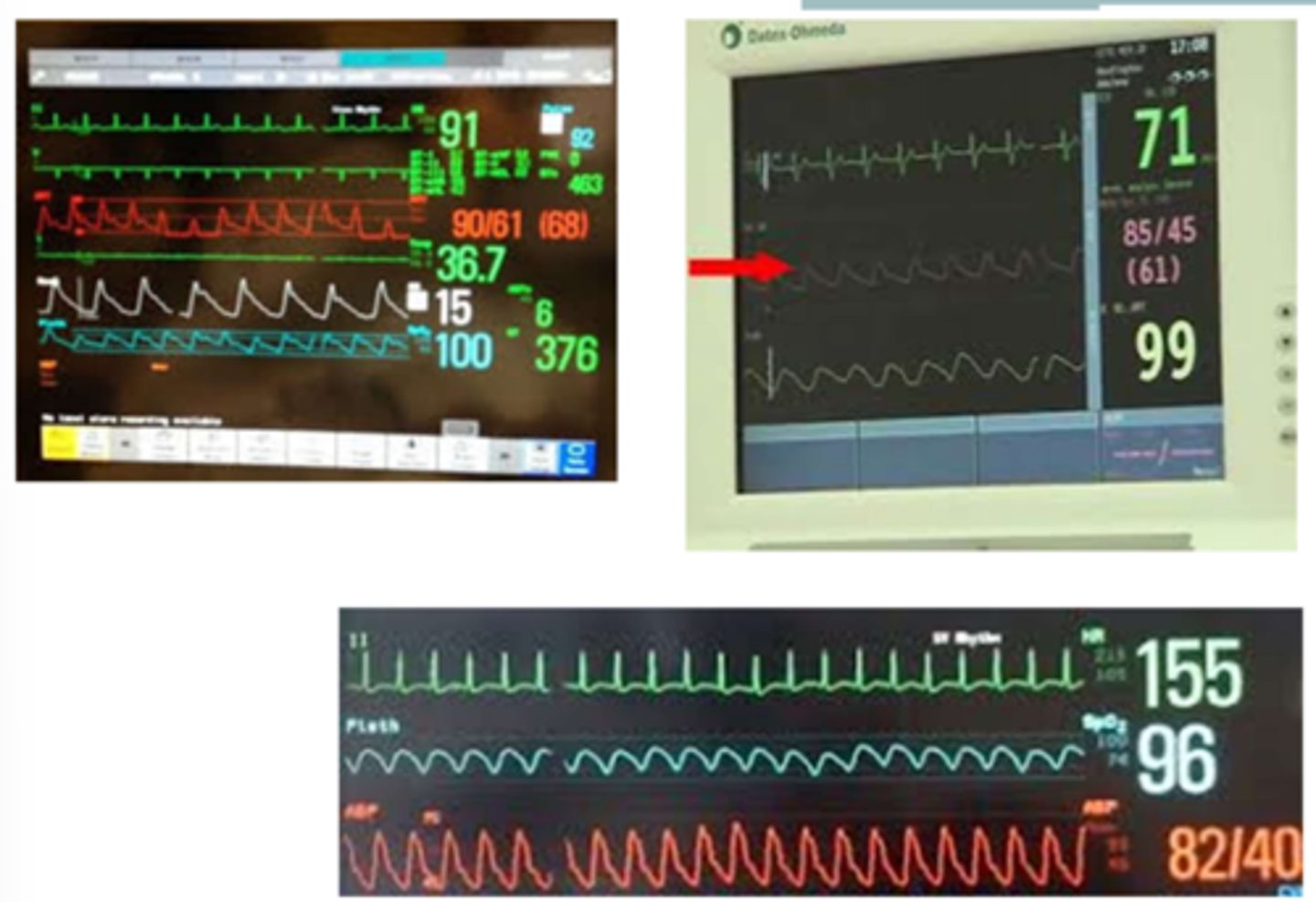 <p>Proposed Activity Guidelines - Femoral Lines:</p><p>- Safety: Able to follow commands</p><p>- Hemodynamically stable:</p><p>→ Resting HR &lt;______________ bpm</p><p>→ MAP __________________ mmHg</p><p>→ FiO2 &lt;_________________</p><p>- Types of femoral lines:</p><p>→ Central venous catheters</p><p>→ Dialysis catheters</p><p>→ Arterial catheters</p><p>- Inspection: Before and after sessions (document that line was in place)</p><p>- Mobility Activities:</p><p>→ Transfers to EOB</p><p>→ _____________________ EOB with or without assist</p><p>→ Standing at bedside</p><p>→ Transfer to stretcher chair or regular chair</p><p>→ Ambulation</p><p>→ No repeated hip flexion</p><p>- 210 PT sessions, 630 mobility activities, NO ADVERSE EVENTS</p>