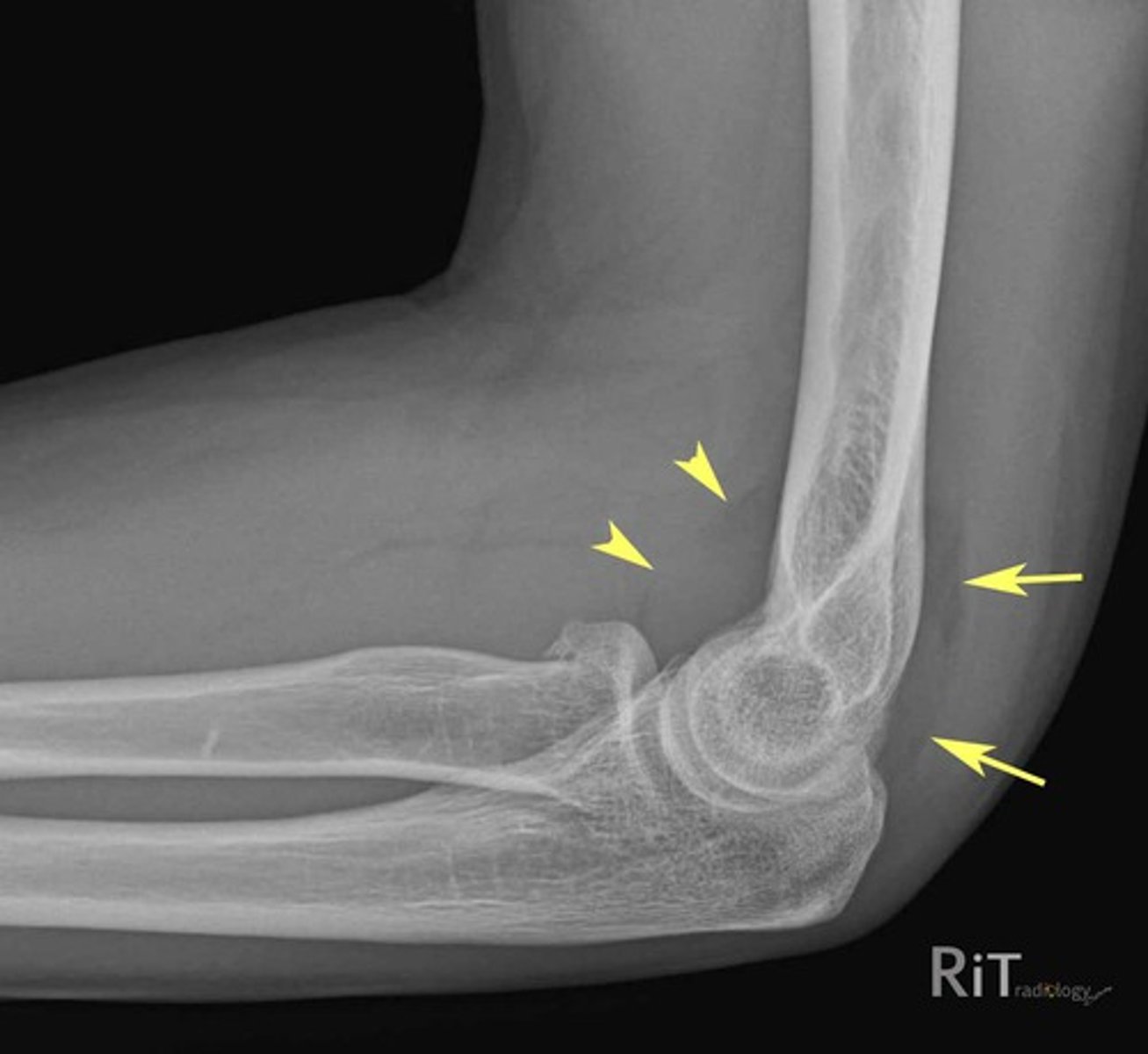 <p>bleeding into soft tissue or pathological fracture</p>