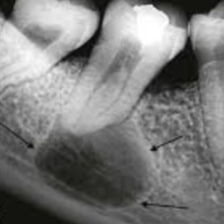 <p>What does it mean if a Cyst is Corticated, Smooth?</p>