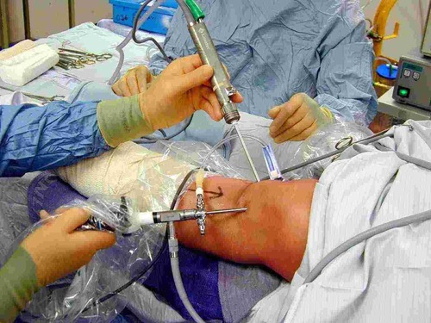 <p>Using delicate machines to operate on a patient - usually whilst using an endoscope. This is to make the amount of harm to the body less (minimally invasive) and reduce recovery times</p>