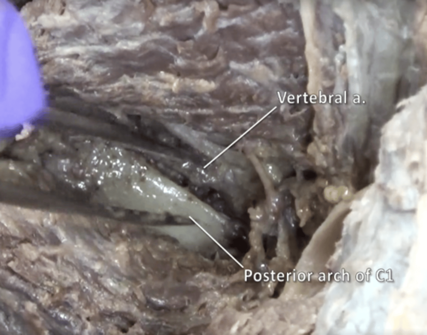 <p>Supplies blood to the spinal column and brain. Located between rectus capitis posterior major and obliquus capitis inferior</p>
