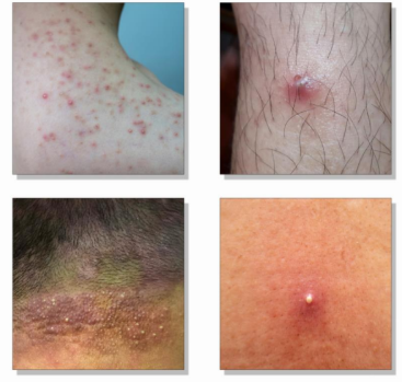 <p>Inflammation/infection of the</p><p>hair follicle.</p><p>Main pathogen: </p><ul><li><p>Staphylococcus aureus</p></li></ul><p>Common sites: beard, scalp, chest,</p><p>thighs</p><p>Predisposing factors: shaving, friction,</p><p>occlusion, sweat</p><p>Treatment: hygiene + topical antibiotics</p><p>(mupirocin, clindamycin)</p>