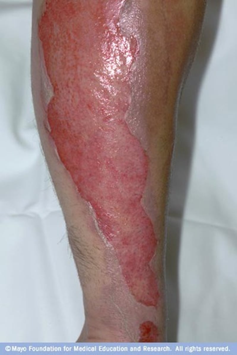 <p>epidermis/some dermis; mottled red, intact weeping blisters, blanches to pressure with quick capillary refill, extremely painful; heals in 10-14 days with minimal scarring</p>
