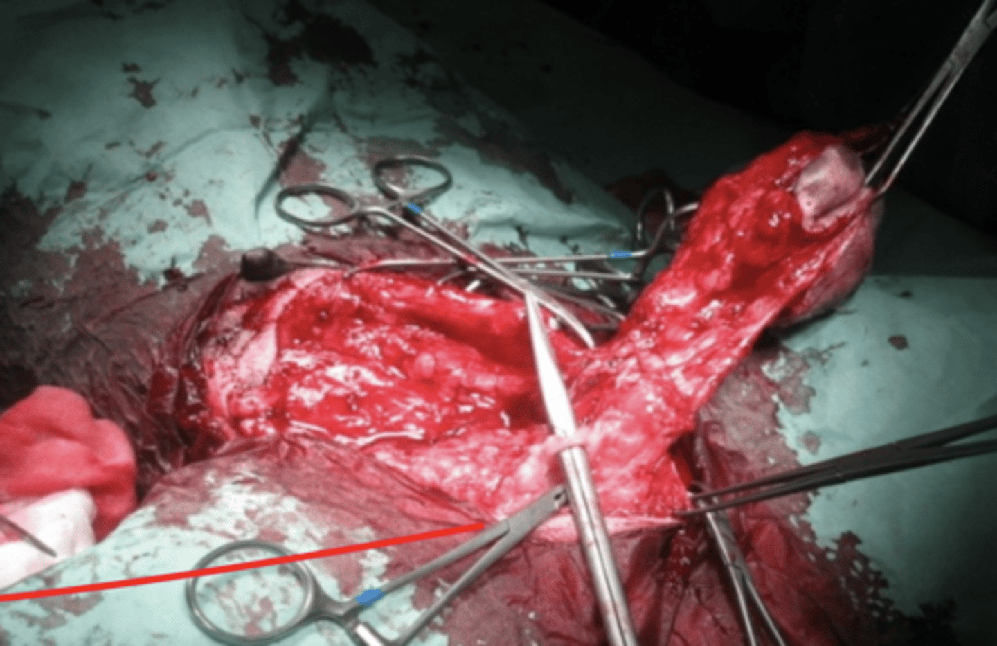 <p>la arteria que riega esta mama</p><p>M1+2 → torácica interna y externa</p><p>M2+3 → epigástrica superficial craneal</p><p>M4+5 → epigástrica superficial caudal</p>