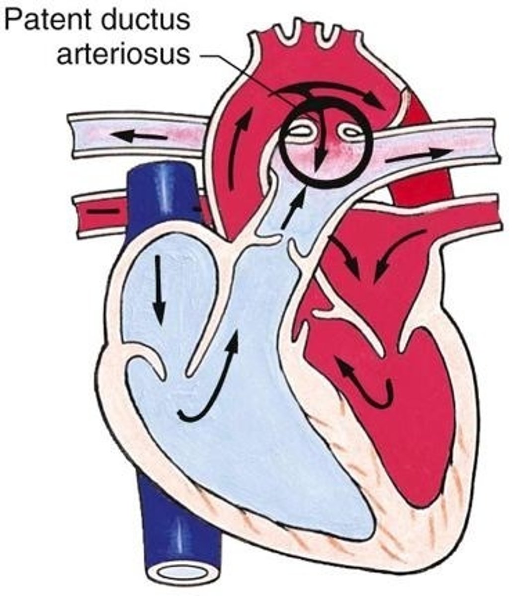 <p>patent ductus arteriosus</p>
