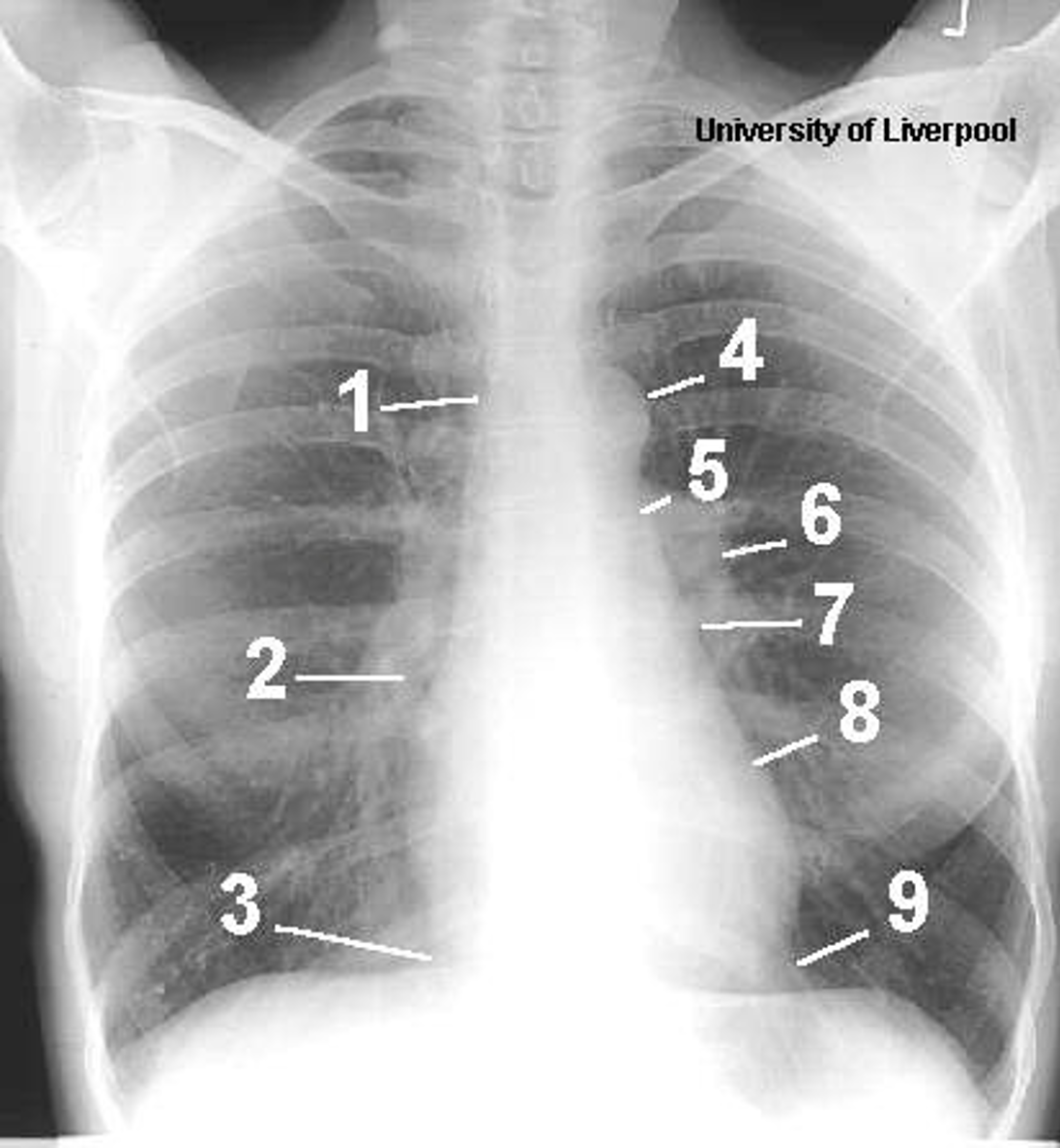 <p>Name the mediastinal contours according to the numbers </p>