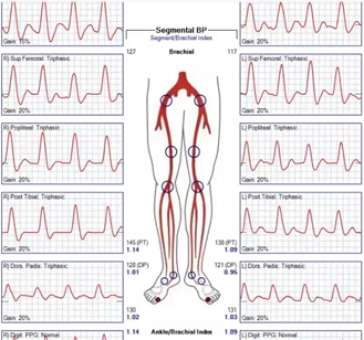 <p>Pt presents with hx of CAD,HTN,DM x 22 years of smoking x 40 years. you obtain these waveforms and ABI info</p><p>1.are the results of study normal?</p><p>2.is ABI reliable? why or why not?</p>