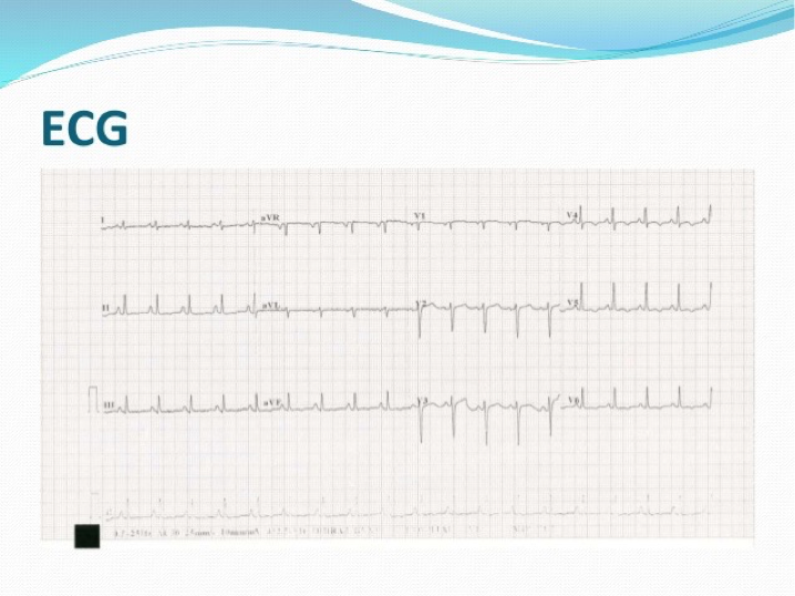 <p>What does this refer to</p><ul><li><p>generalized T wave flattening or inversion, with normal QRS</p></li></ul><p></p>