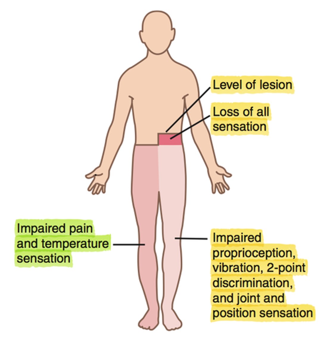 <p>What: Hemisection of the spinal cord due to GSW or stab</p><p>Results:</p><p>Ipsilateral deficits</p><p>-loss of sensation (LT, proprioception, vibratory sense) (dorsal columns) and paralysis of muscles (corticospinal tract)</p><p>Contralateral deficits</p><p>-Loss of pain and temperature (spinothalamic tract) but does not start until SEVERAl segments below)</p>