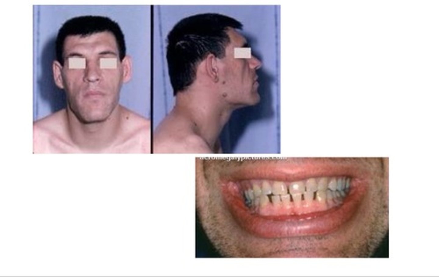 <p>This is caused by an anterior pituitary tumour. Secretes excessive growth hormone leading to excessive growth of the mandible.</p>