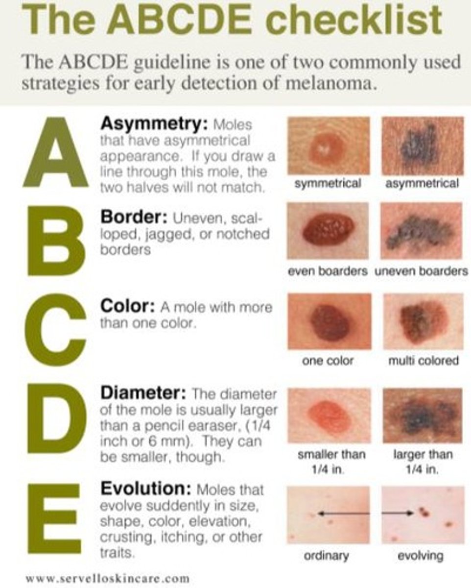 <p>Method for identifying melanoma by assessing Asymmetry, Border, Color, Diameter, and Evolving characteristics of moles.</p>