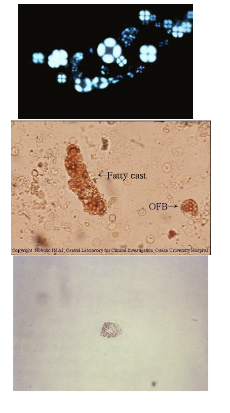 <ul><li><p class=""><span style="color: #fb7506"><strong>RTE cells</strong> that have absorbed <strong>lipids</strong> from glomerular filtrate</span></p></li><li><p class=""><span style="color: #ede10b">Lipid </span>appears <span style="color: #cddc09"><strong>highly refractile</strong></span>; often seen with <strong>fat droplets</strong> or <strong>fatty casts</strong></p></li><li><p class="">Confirm with:</p><ul><li><p class=""><span style="color: red"><strong>Sudan III</strong> or <strong>Oil Red O</strong> </span>(triglycerides/neutral fat)</p></li><li><p class=""><span style="color: #NaNNaNNaN"><strong>Polarized light</strong></span> (cholesterol → <span style="color: #0cfedd"><strong>Maltese cross</strong> pattern)</span></p></li></ul></li><li><p class=""><span style="color: red">May be <strong>confused with starch or crystals</strong></span></p></li></ul><p></p>