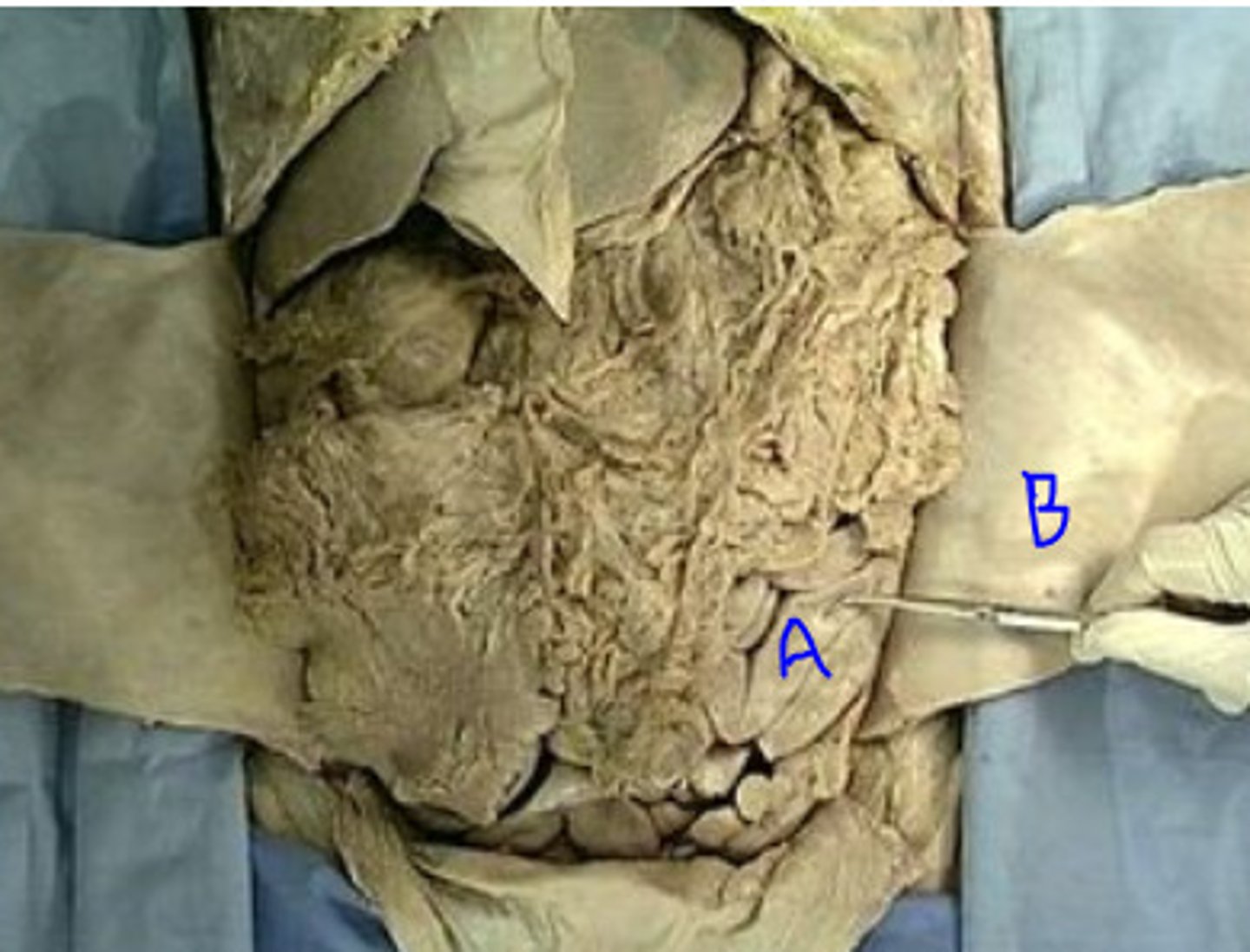 <p>A: the inner layer the surround organs</p>
