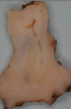 <ul><li><p>75% arise in the mandible, almost always in the molar/premolar region</p></li><li><p>Typically, only affect permanent teeth (especially 1st mandibular molars)</p></li></ul><p></p>