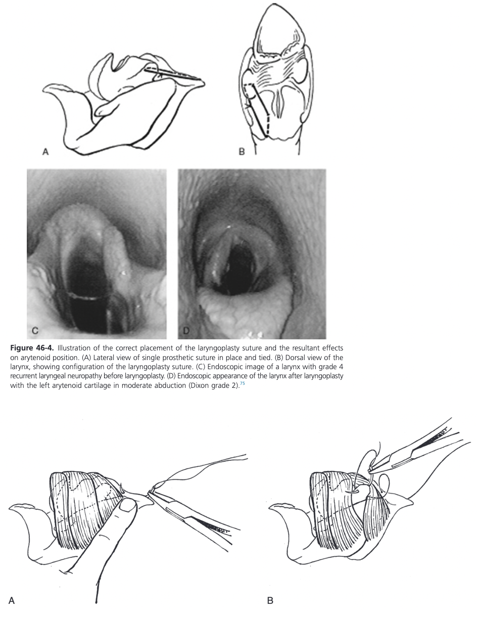 <ul><li><p><span>Lateral recumbency with head and neck extended</span></p></li><li><p><span>Videoendoscope secured transnasally</span></p></li><li><p><span>10-12 cm incision made immediately ventral and parallel to the linguofacial vein, extending caudally from a point 4 cm cranial to the ramus of the mandible</span></p></li><li><p><span>Linguofacial vein dissected from the lateral margin of the omohyoideus muscle</span></p></li><li><p><span>Elevate the linguofacial vein at the middle of the incision to expose the cleavage plane between the cricopharyngeus and cricothyroideus muscles which is digitally opened and enlarged</span></p></li><li><p><span>Caudal border of the cricoid cartilage is bluntly freed from connective tissue</span></p></li><li><p><span>Exposure of the dorsal aspect of the cricoid cartilage is improved by lateral traction of the cricoid cartilage using a towel clamp held by the surgeon</span></p></li><li><p><span>Muscular process exposed by sharply separating the cricopharyngeus and thyropharyngeus muscles along the junction of their aponeurosis</span></p></li><li><p><span>Elevate the wide isthmus of the esophagus and its adventitia</span></p><ul><li><p><span>Alternatively, a plane of dissection can be created off the back edge of the cricopharyngeus muscle under the vascular plexus that lies over the CAD muscle</span></p></li><li><p><span>Rostral retraction of the cricopharyngeus muscle often exposes almost the entire CAD muscle and musclar process without interference from the cricopharyngeus muscle</span></p></li></ul></li><li><p><span>Rotating the larynx laterally by placing a spay hook on the thyroid lamina improves the exposure of the muscular process</span></p></li><li><p><span>Suture materials that have been used include braided polyester with (#5 Ti-Cron) or without silicone coating, 6 mm surgical stainless-steel wire, braided lycra, Polyblend suture, Polyblend tape, and nylon</span></p></li><li><p><span>Prosthetic suture first placed through the cricoid cartilage</span></p></li><li><p><span>Use of two sutures is common and has been shown in vitro to be mechanically superior to one and results in a larger cross-sectional area of the rima glottidis</span></p></li><li><p><span>Different needles have been used: swaged on, reverse cutting needle on the Ti-Cron, #3 Martin uterine reverse cutting needle</span></p></li><li><p><span>Using the left index finger as a guide, the needle is "walked off" the caudal edge of the cricoid cartilage 2-3 mm lateral to the dorsal midline until the point slips under the cartilage (there is a palpable notch in the cricoid cartilage at this site) and the needle is advanced in a cranial direction will avoiding penetration into the lumen of the larynx and then the needle is rotated to penetrate the cricoid cartilage 2-3 cm cranial to its caudal border and 1 cm lateral to the dorsal ridge</span></p><ul><li><p><span>Alternatively, both strands of a suture can be passed through a titanium button prior to placing the suture through the cricoid cartilage</span></p><ul><li><p><span>Can consistently be placed at a planned distance from the sagittal ridge of the cricoid cartilage through a thicker portion of cricoid cartilage and result in a constant angle of tension in relation to the muscular process</span></p></li><li><p><span>If this technique is used, the needle should be advanced no more than 1 cm from the caudal border of the cricoid cartilage to allow proper "docking" of the button to the ventral aspect of the cricoid cartilage</span></p></li></ul></li></ul></li><li><p><span>When the needle has been drawn through the cartilage and out of the incision, the needle is cut off and the suture ends are tagged with a small hemostat</span></p></li><li><p><span>Second suture is usually placed 10 mm lateral to the first using the same technique</span></p></li><li><p><span>If the cricopharyngeus muscle has not been retracted forward, a Glover forceps is passed under the cranial aspect of the cricopharyngeus muscle to bring both ends of the first and second suture cranial toward the muscular process of the cricoid cartilage</span></p></li><li><p><span>Placement of the suture through the muscular process can be achieved by a variety of techniques</span></p><ul><li><p><span>Heavy needle drivers and a reverse cutting #6 Mayo needle or #6 Martin uterine needle</span></p></li><li><p><span>Use of 3 mm bone trocar to create a tunnel for the suture has been reported to reduce fissure formation and risk of cartilage failure from suture pullout</span></p></li><li><p><span>12 to 16 gauge Jamshidi needle can also be used</span></p></li><li><p><span>Prosthesis can be placed through a loop of #1 stainless-steel wire that is then passed through the tunnel in the muscular process</span></p></li></ul></li><li><p><span>Before needle placement, the cricoarytenoideus articulation should be opened and curetted or rasped to facilitate early ankyloses of the joint</span></p><ul><li><p><span>Some transect the tendon of insertion of the CAD muscle onto the muscular process to access the joint while others use a curbed Crile hemostatic forceps to create access for a curette or Miller rasp</span></p></li><li><p><span>Goal of this step is to reduce the loss of abduction frequently observed in the early postoperative period</span></p></li><li><p><span>To enhance this further injection of PMMA has been advocated as a better method of joint ankylosis</span></p></li></ul></li><li><p><span>Removal of the attachment of the cricoarytenoideus tendon has been hypothesized to reduce the opportunity for cycling of the prosthesis in horses with grade 3 RLN which is thought to increase the early postoperative loss of arytenoid abduction</span></p></li><li><p><span>Typically the needle is passed through the muscular process from the caudomedial aspect to the craniolateral aspect</span></p><ul><li><p><span>Some prefer to pass the hypodermic or Jamshidi needle from caudolateral to craniomedial, parallel to the cricoarytenoid joint</span></p></li><li><p><span>Needle can also be placed in a caudal to cranial (sagittal) direction</span></p></li></ul></li><li><p><span>After removal of the needle, tension is placed on the cranial and caudal ends of the suture to remove any slack, ensuring the prosthesis is tight against the larynx</span></p><ul><li><p><span>If a trocar is being used, both sutures can pass through a single tunnel; otherwise the second suture is placed approximately 5-10 mm more cranial in the muscular process</span></p></li></ul></li><li><p><span>Engaging the spine of the muscular process rather than its tip is essential to achieve maximal biomechanical advantage and to avoid early pull-through of the prosthesis</span></p></li><li><p><span>The trailing ends of the prosthetic sutures can be drawn under the cricopharyngeus muscle if necessary with a hemostat and the sutures are tied</span></p></li><li><p><span>When using suture as the prosthesis, leaving the cut ends 1.5-2 cm long can allow the knot to be undone and retied if repeat laryngoplasty is performed within the first week of the original surgery</span></p></li><li><p><span>After sutures have been tied, the thyropharyngeus and cricopharyngeus muscles are reapposed with simple continuous suture</span></p></li></ul>