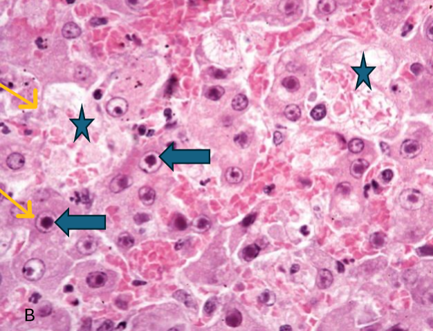 <p>large basophilic intranuclear viral inclusions (blue arrows)</p>