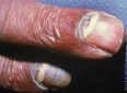 <p><strong>Clinical Manifestations of Onychomycosis Due to Candida Infection</strong></p><p>-Affects the _______, especially the dominant hand</p><p>-About 70% of cases involve the middle finger </p>