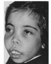 <p>Many of the Features of the Syndrome related to physiological response that represents an effort to compensate for the physiological deficit associated with the inherited mutation Hypoxia &gt; high EPO&gt; bone marrow hyperplasia Increased haematopoiesis distorts bones</p>