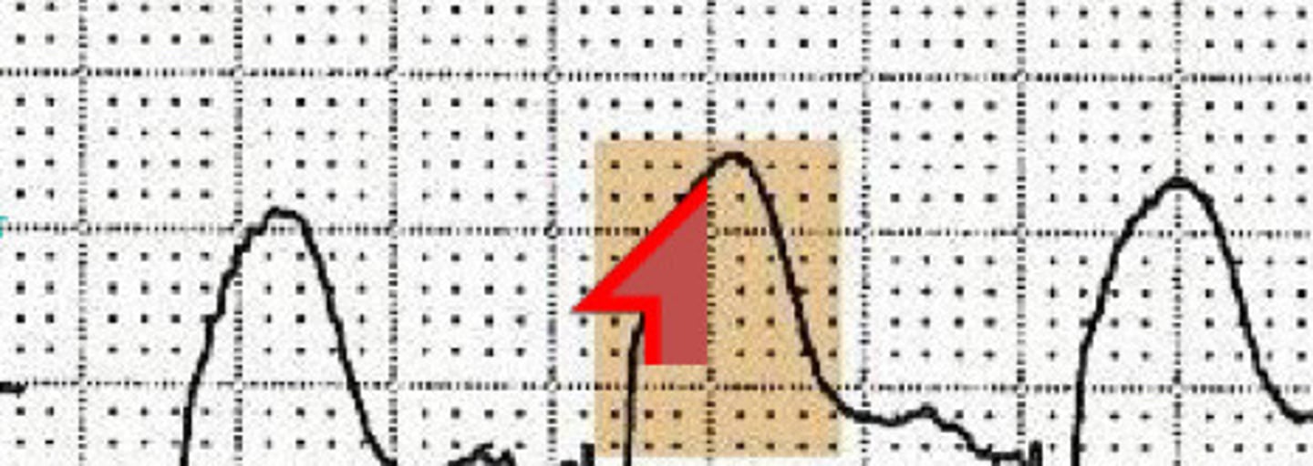 <p>What condition does this ECG indicate</p>