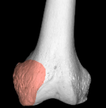 <p>large bump on medial side of femur</p>