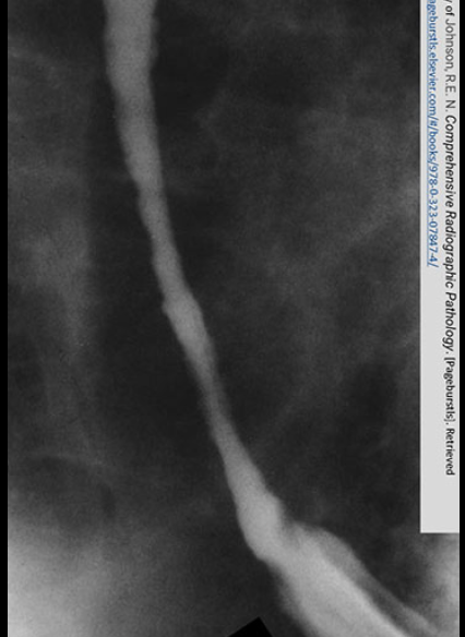 <p><span><span>Obvious narrowing of the lower esophagus due to reflux. Notice the erosion. </span></span></p><p></p>