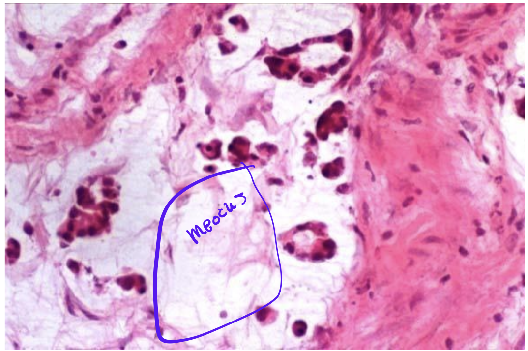 <p>Identify the <strong>organ</strong> and the <strong>diagnosis</strong> in this format: <em>diagnosis, organ</em></p>