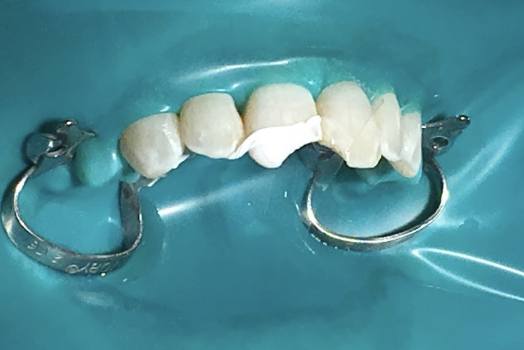<p>If you have salivary contamination, what is highly compromised?</p>