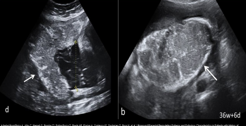 <p>which placental grade shows the cotyledons on US exam</p><p>a) 0</p><p>b) 1</p><p>c) 2</p><p>d) 3</p>