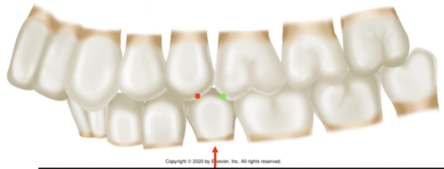 <p>ID the occlusion classification:</p>
