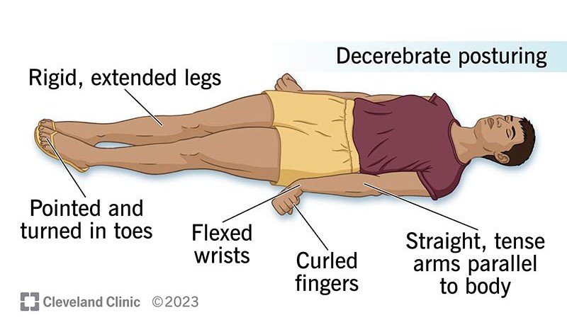 <ul><li><p>Arms and legs <strong>extended straight</strong>, flexed wrists , head arched back</p></li><li><p>Indicates <strong>damage to the brainstem</strong></p></li><li><p>Usually a more severe sign than decorticate posturing</p></li></ul><p></p>