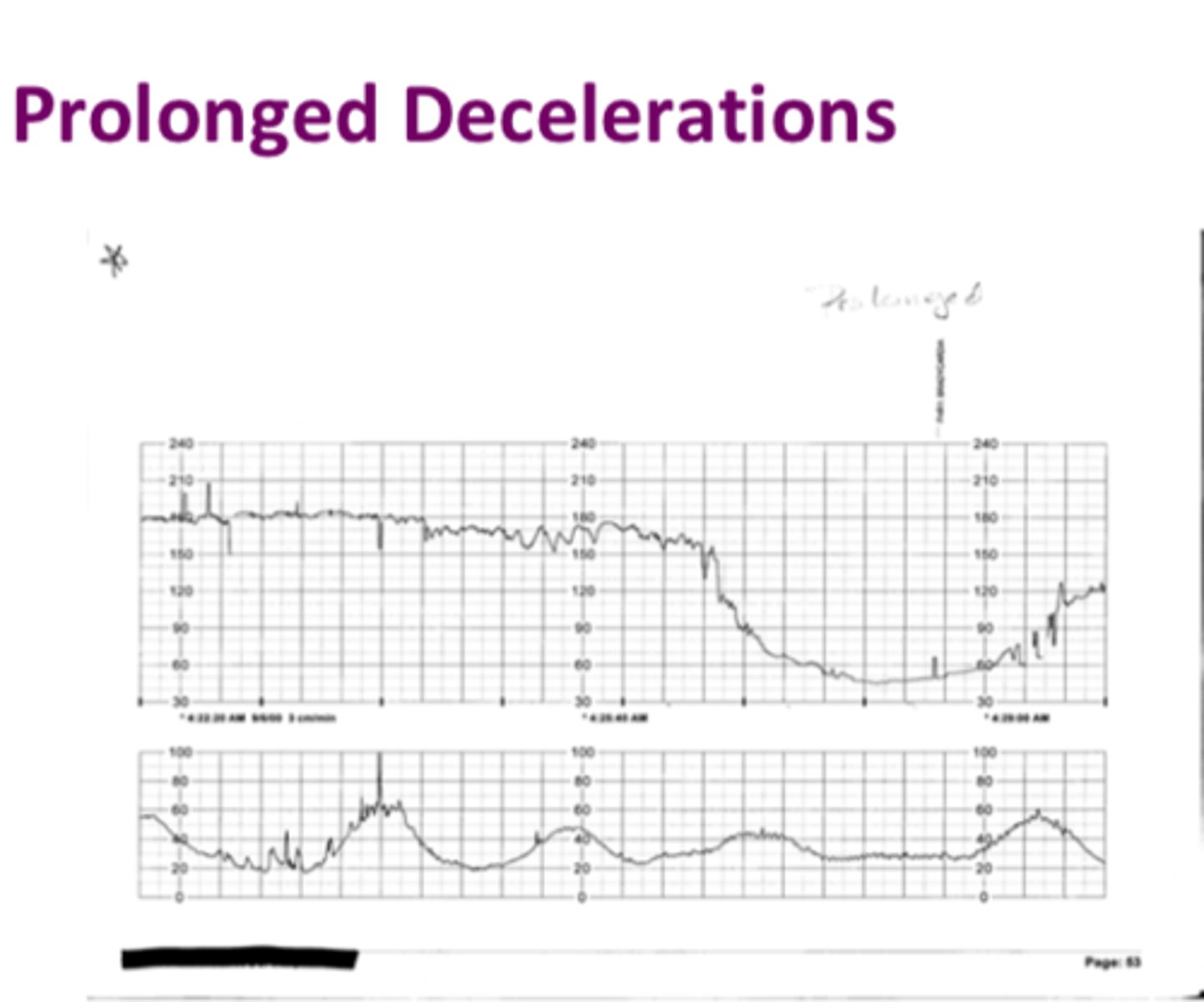 <p>These decelerations are abrupt, FHR decreases of at least 15 bpm from baseline longer than 2 minutes but less than 10 minutes</p>