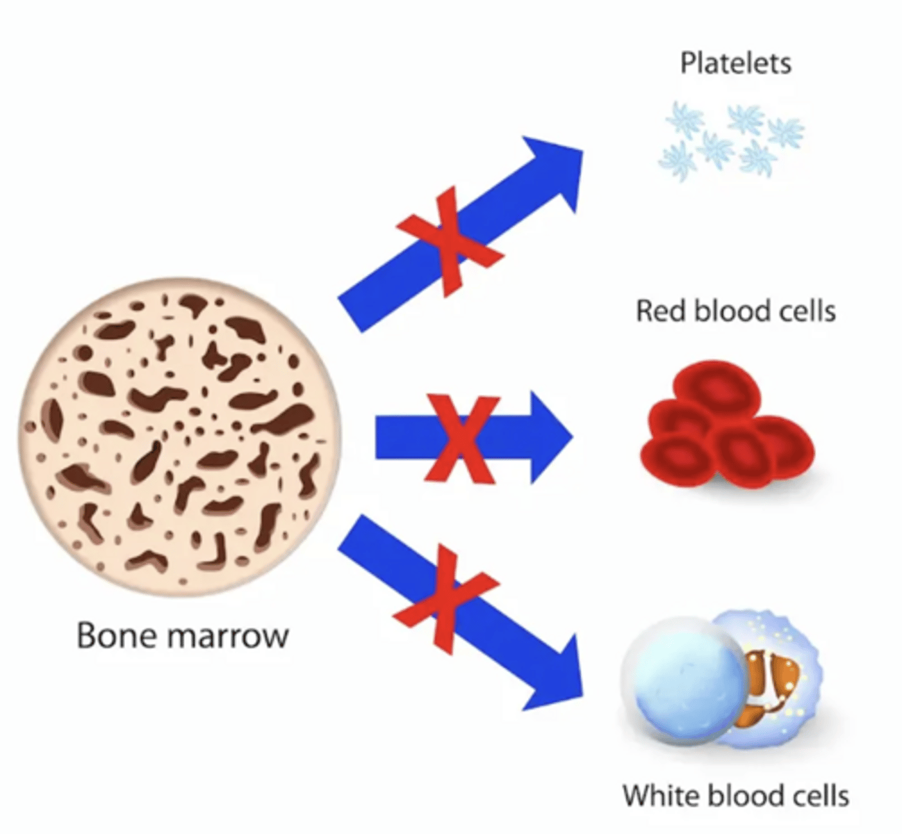<p>-aplastic anemia develops in 80% (bone marrow stops making blood cells)</p><p>-thrombocytopenia</p>