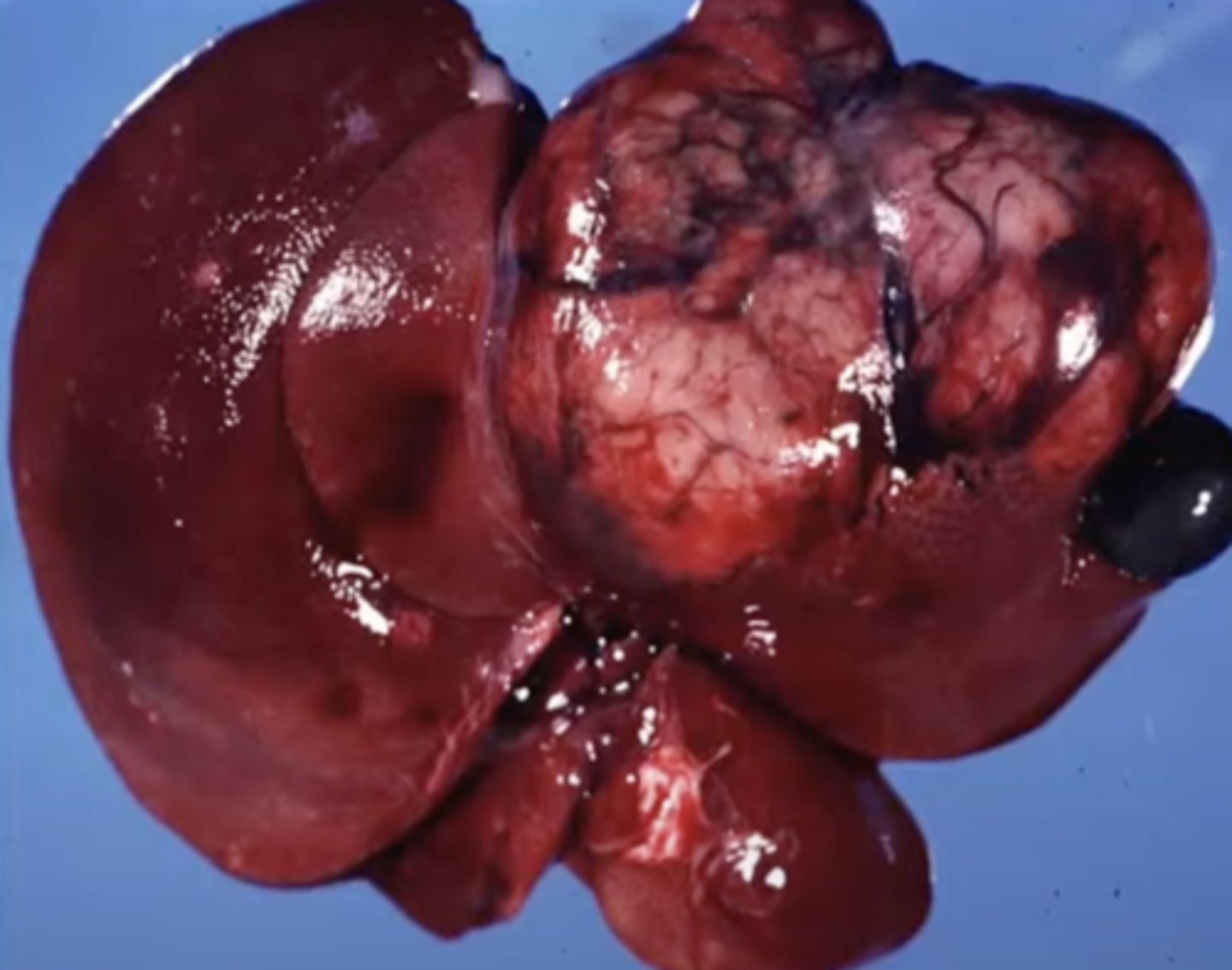 <p>What has caused this gross appearance of this liver?</p>