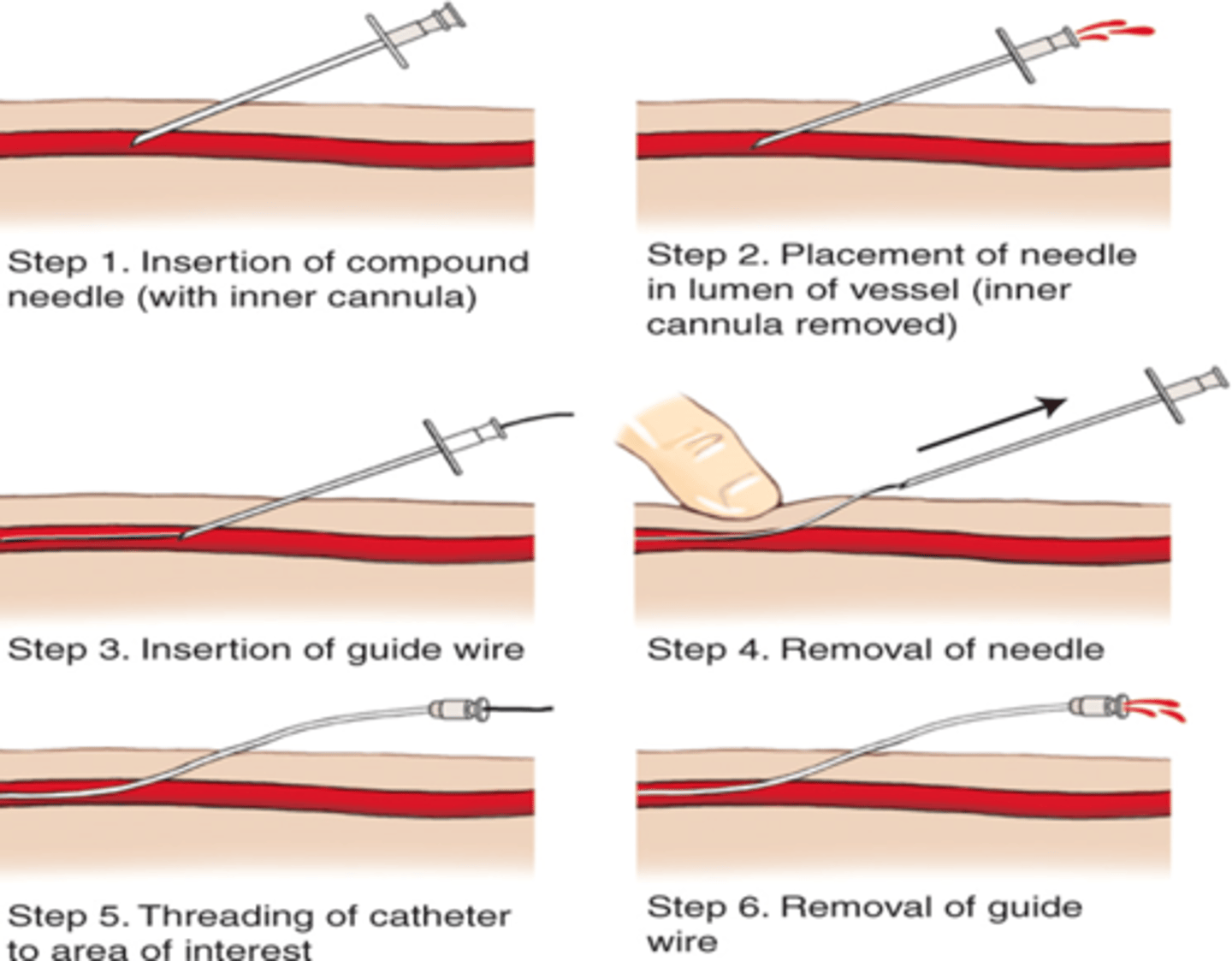 <p>-J-type guide wire curls spontaneously minimizing damage to intima of vessel. Should be pointed inferiorly in subclavian approach to prevent wire from going up jugular instead of down into SVC</p><p>-Insert large bore needle with syringe attached through skin, constantly withdrawing until venous flashback is obtained. Stop advancing and hold needle in place.</p><p>-Remove syringe Insert guide wire through needle until only 2-3 cm remain protruding. NEVER LET GO OF THE GUIDE WIRE.</p><p>-Remove needle, leaving guide wire in place. Always hold the guide wire.</p><p>-Enlarge entry point using tip of a scalpel blade.</p><p>-Pass dilator through catheter. Advance to skin leaving 1-2 cm of wire exposed.</p><p>-Slowly remove guide wire from skin through catheter until end of wire appears out open end of catheter.</p><p>-Advance catheter/dilator complex into vessel. Use forward pressure and twisting motion advancing catheter through skin to hub of catheter.</p><p>-Remove dilator and guide wire simultaneously from catheter.</p><p>-Draw blood from each port</p><p>-Flush with saline, clamp off</p><p>-Suture line in place</p>