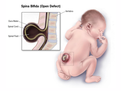 <p>Special case: pregnancy</p><p>- Deficiency: neural tube defects (spina bifida)</p><p>- Neural tube closes 21-28 days after conception - may not know are pregnant</p><p>- Supplementation of grains is a public health success story</p><p>- However: supplements + fortification can result in toxicity (insomnia, malaise, irritability, GI distress)</p>