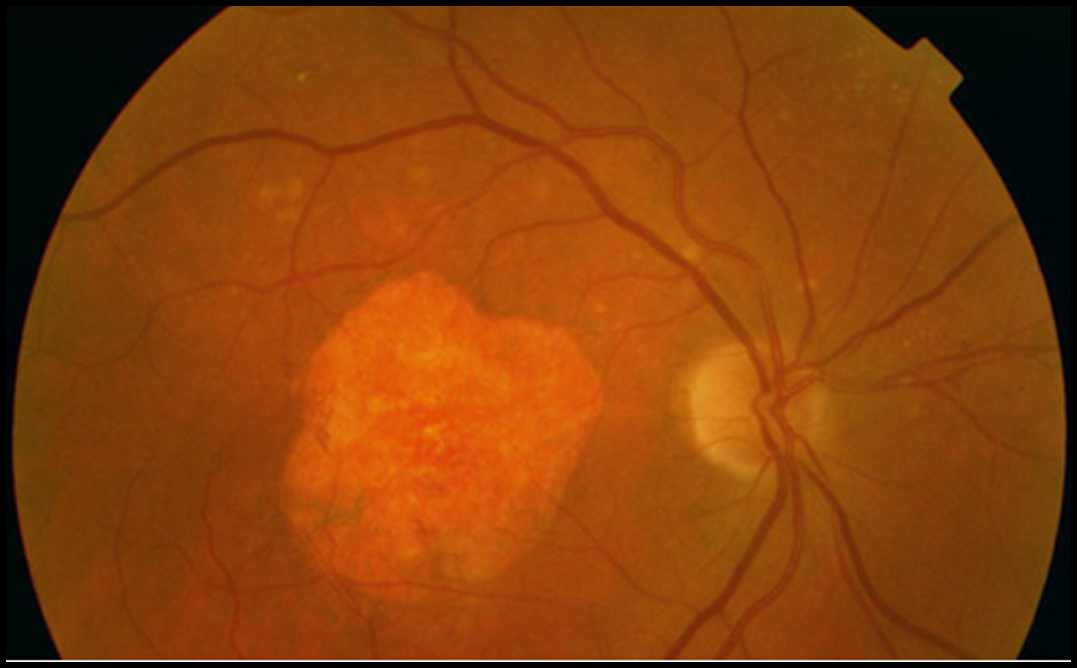 <p>slow breakdown of cones/rods; patchy focal atrophy and extensive confluent atrophy</p>